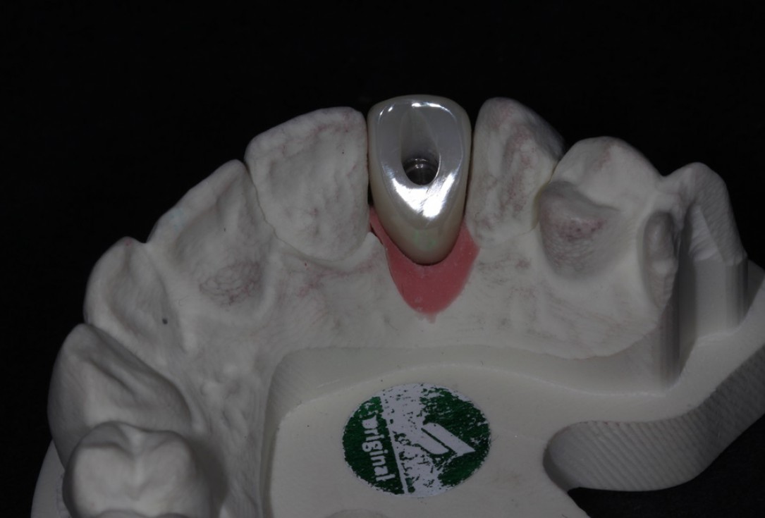 Block augmentation with maxgraft® in the maxilla - Dr. R. Cutts