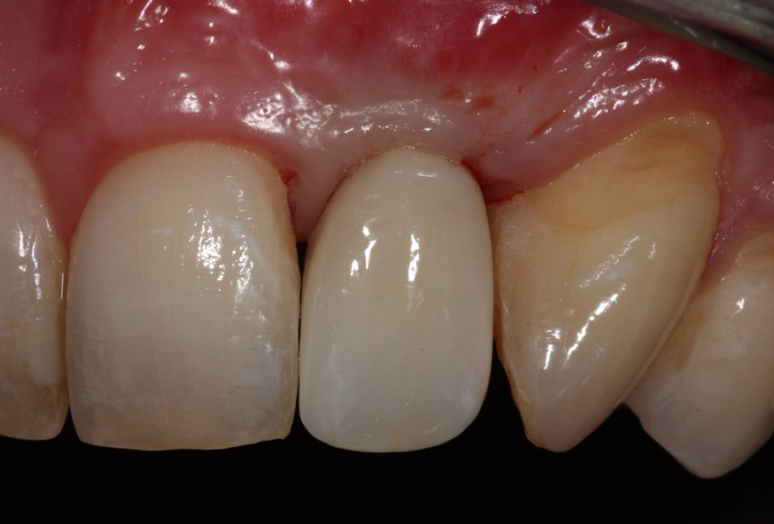 Block augmentation with maxgraft® in the maxilla - Dr. R. Cutts