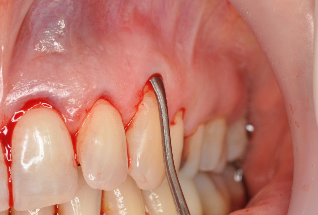 02/09 Multiple gingival recessions treated by MCAT in conjunction with mucoderm® and Straumann® Emdogain® - Hangyási
