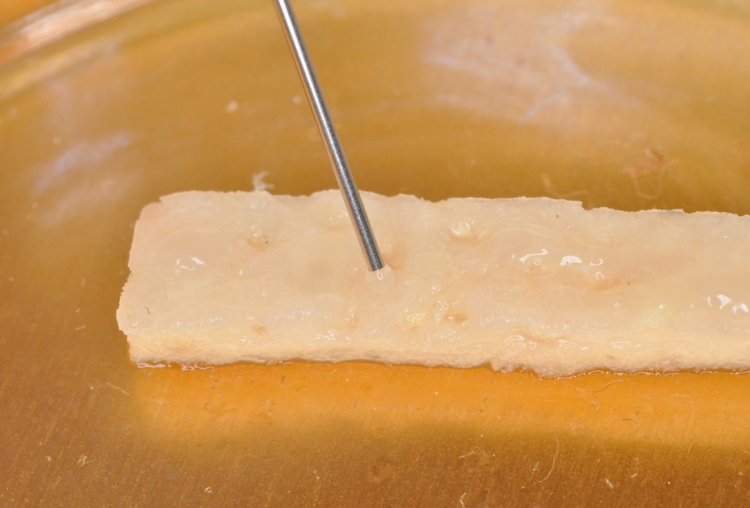 03/09 Multiple gingival recessions treated by MCAT in conjunction with mucoderm® and Straumann® Emdogain® - Hangyási