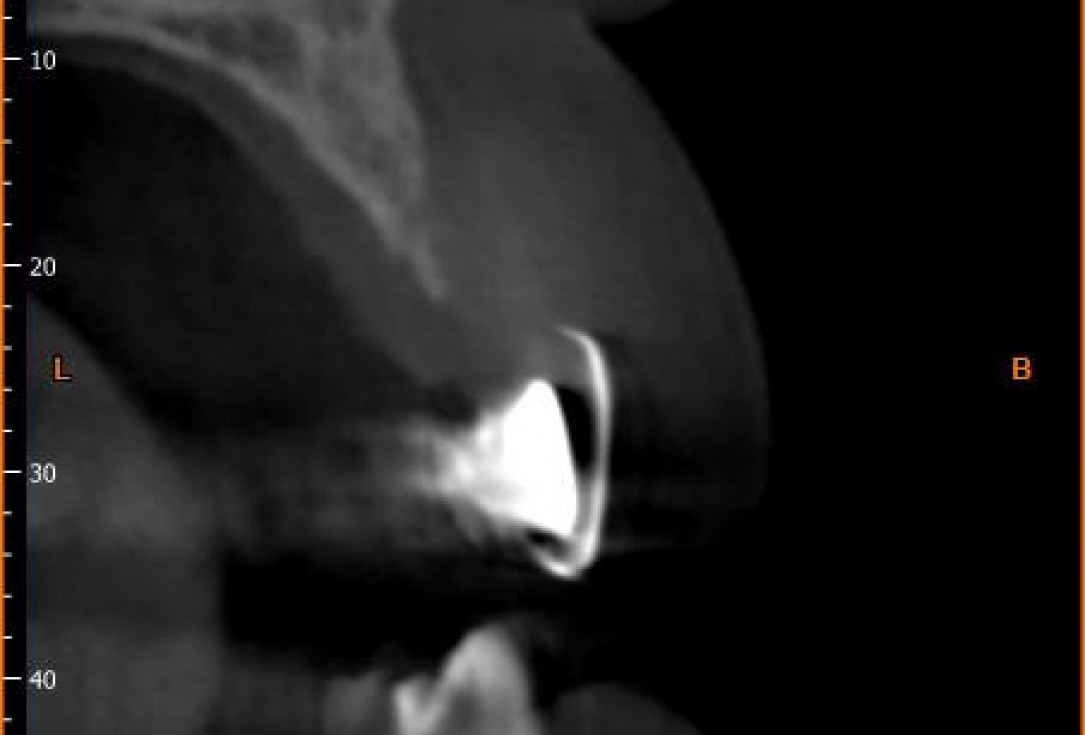 Block augmentation with maxgraft® in the maxilla - Dr. R. Cutts