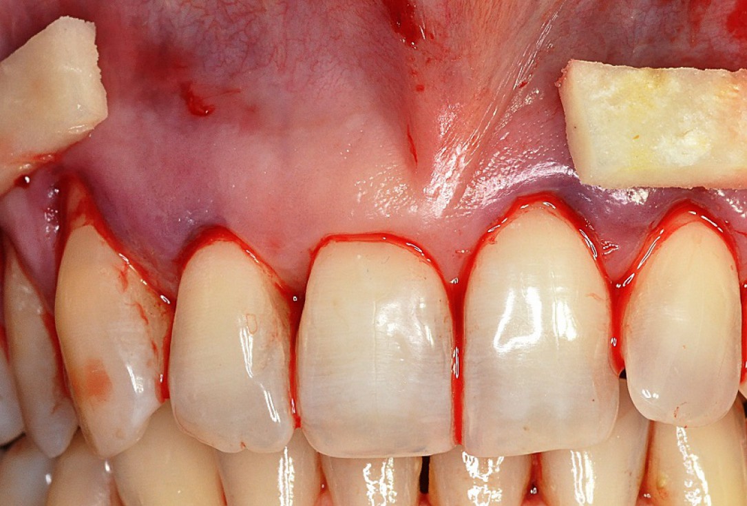 05/09 Multiple gingival recessions treated by MCAT in conjunction with mucoderm® and Straumann® Emdogain® - Hangyási