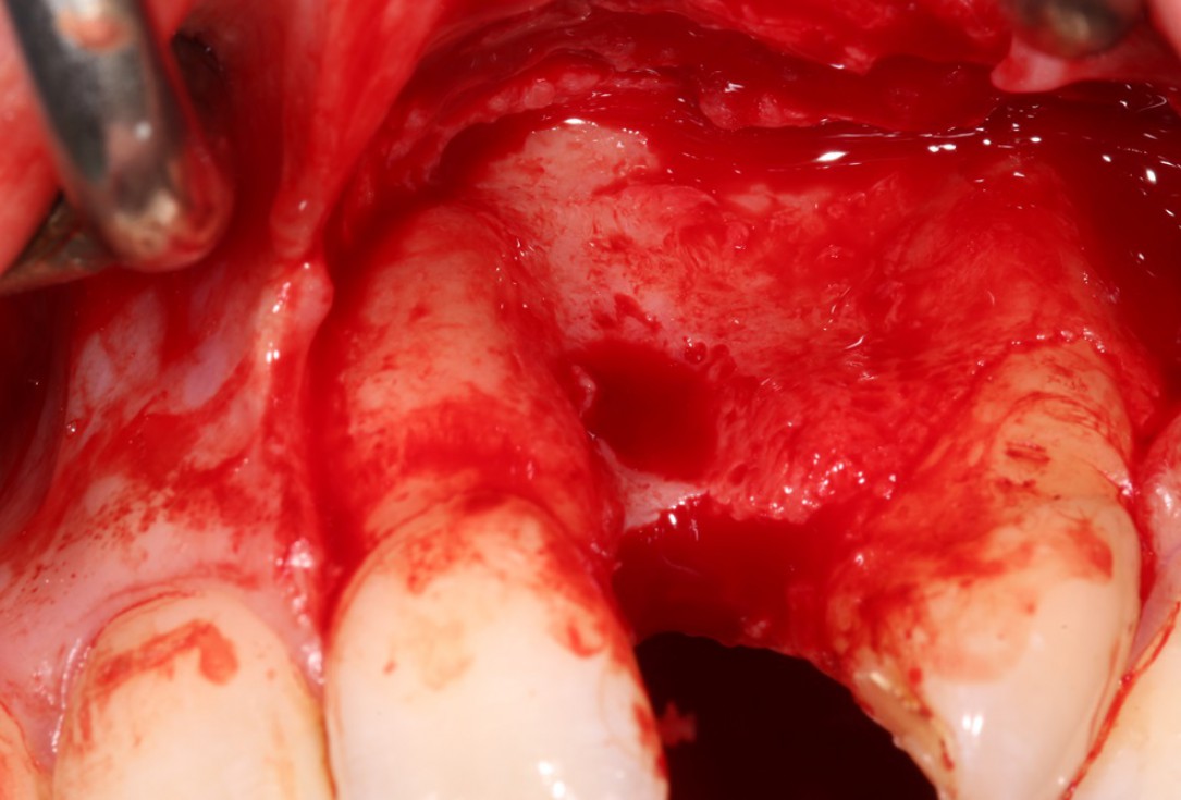 Block augmentation with maxgraft® in the maxilla - Dr. R. Cutts