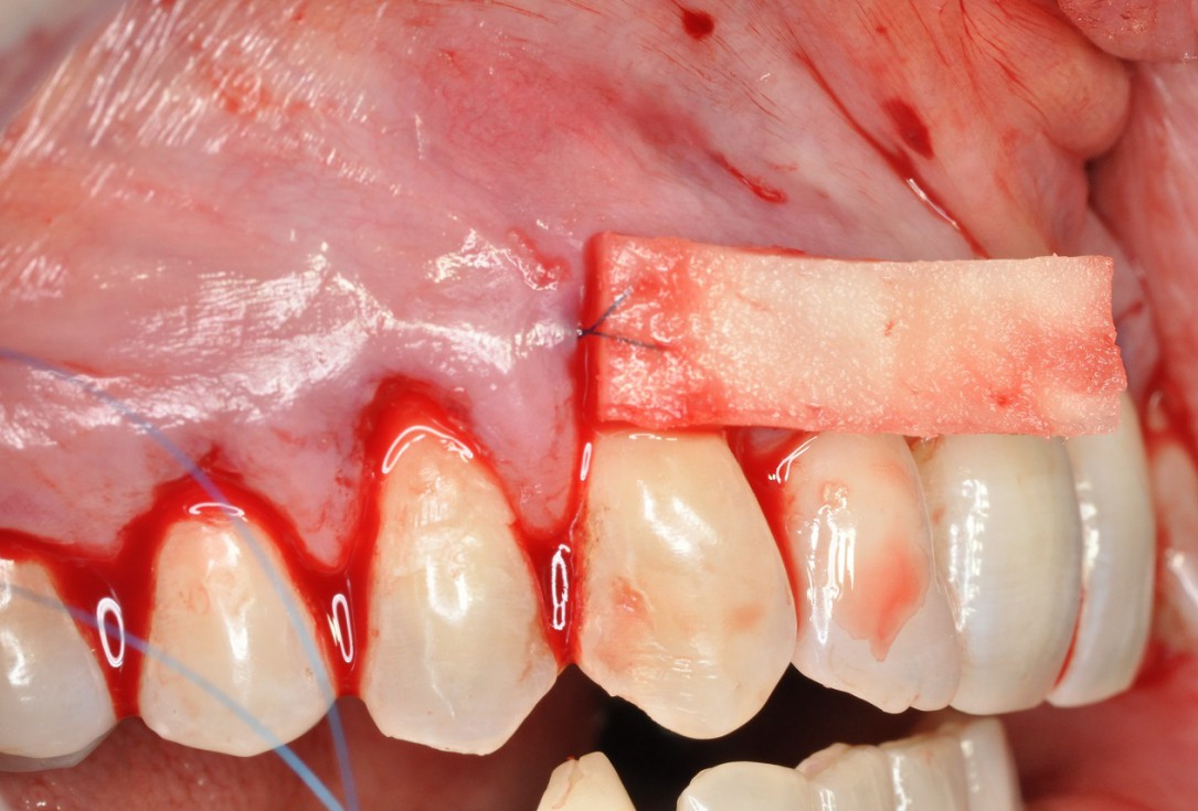 06/09 Multiple gingival recessions treated by MCAT in conjunction with mucoderm® and Straumann® Emdogain® - Hangyási