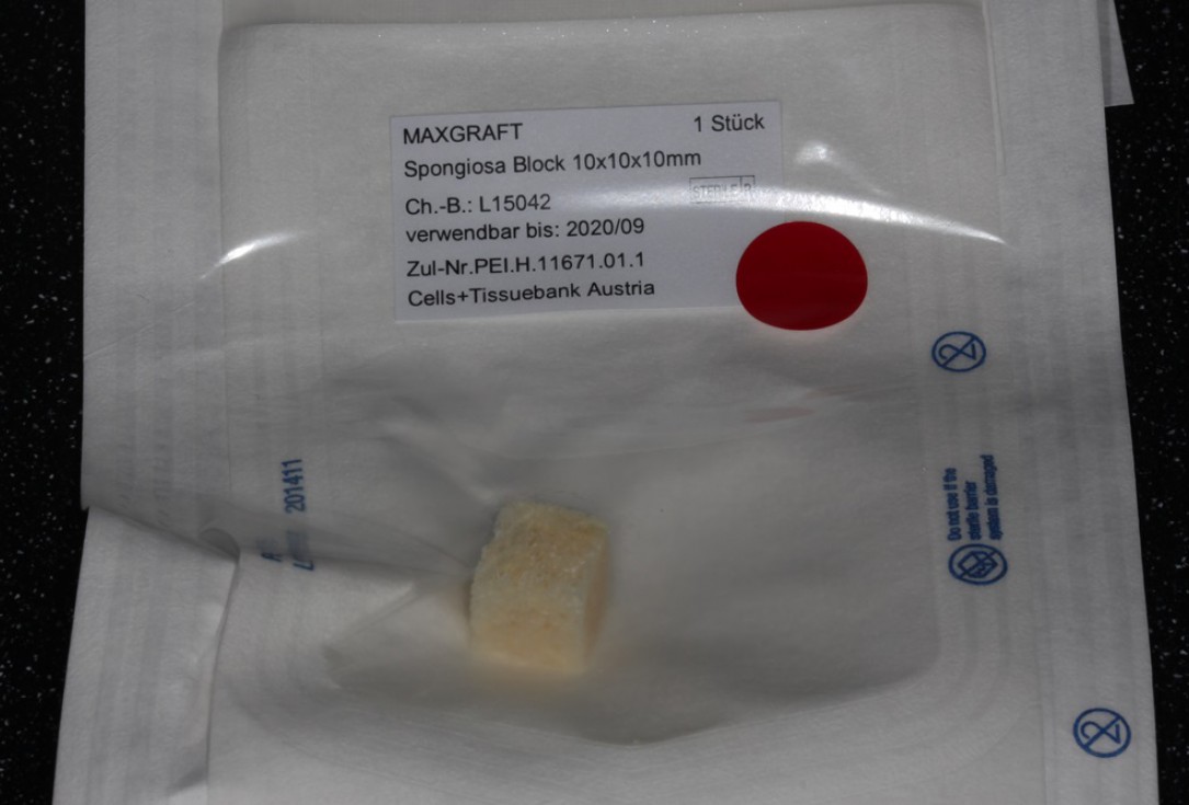 Block augmentation with maxgraft® in the maxilla - Dr. R. Cutts