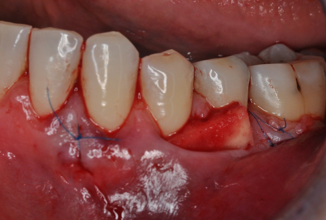 07/09 Multiple gingival recessions treated by MCAT in conjunction with mucoderm® and Straumann® Emdogain® - Hangyási