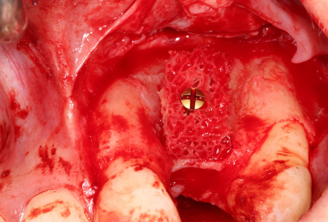 Block augmentation with maxgraft® in the maxilla - Dr. R. Cutts