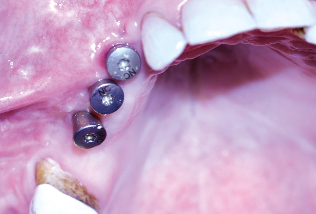 Ridge augmentation with maxgraft® bonebuilder and sinus floor elevation – Dr. K.P. Schiechl