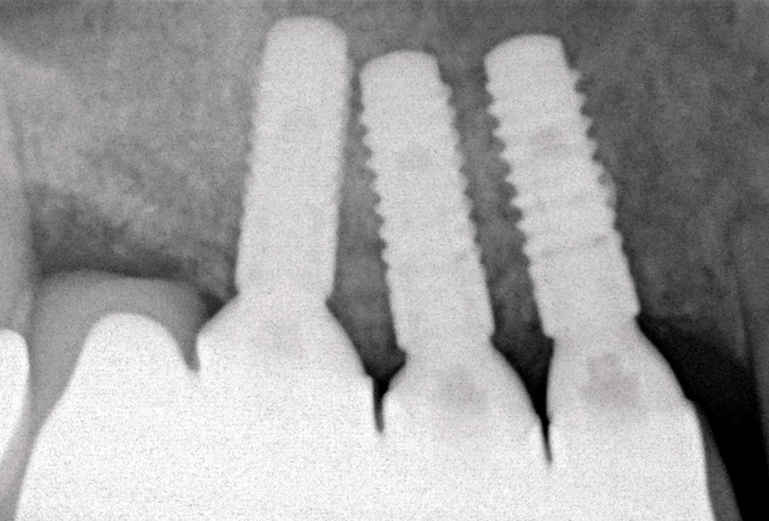 Ridge augmentation with maxgraft® bonebuilder and sinus floor elevation – Dr. K.P. Schiechl