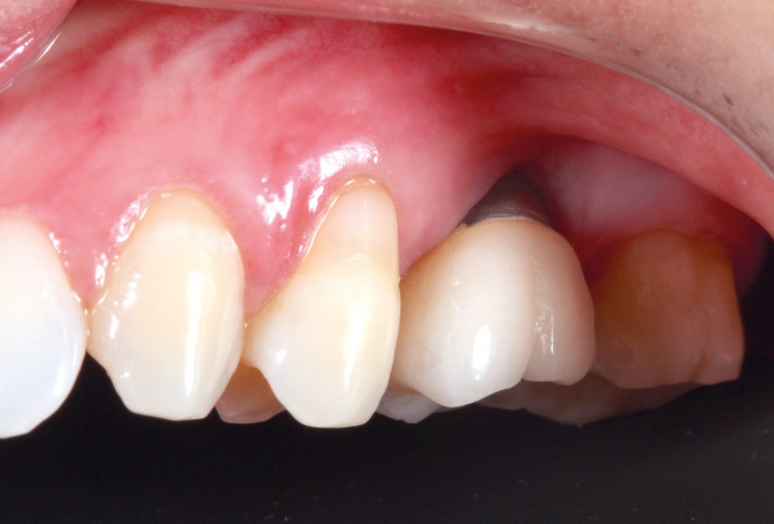 1/9 Soft tissue thickening with mucoderm® - Dr. G. de Deus