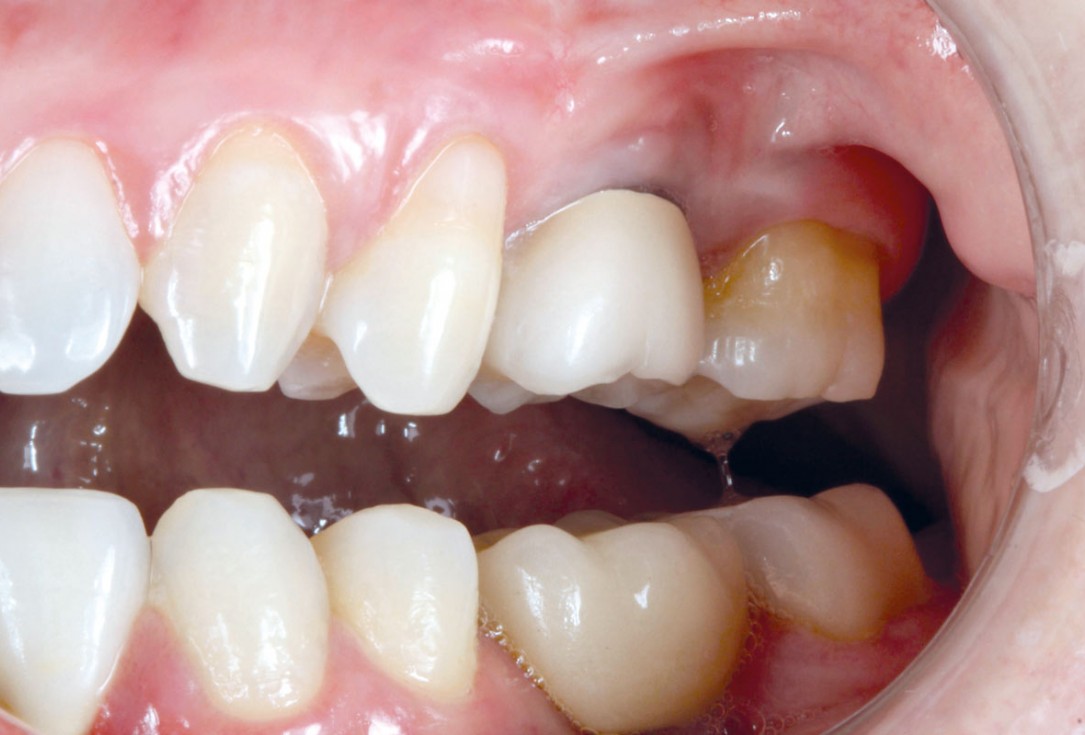 8/9 Soft tissue thickening with mucoderm® - Dr. G. de Deus