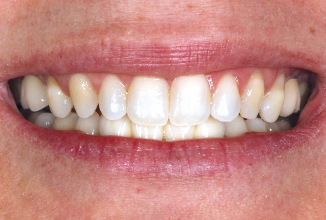 9/9 Soft tissue thickening with mucoderm® - Dr. G. de Deus