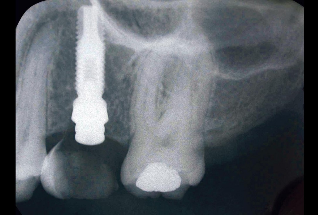 2/9 Soft tissue thickening with mucoderm® - Dr. G. de Deus