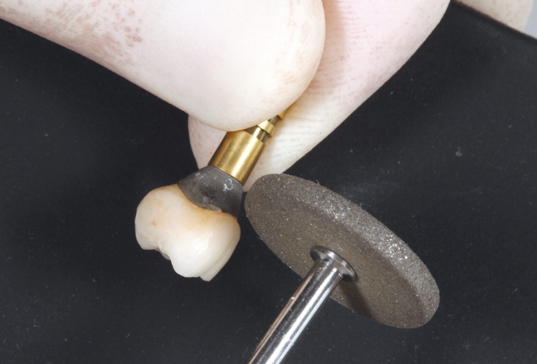 3/9 Soft tissue thickening with mucoderm® - Dr. G. de Deus