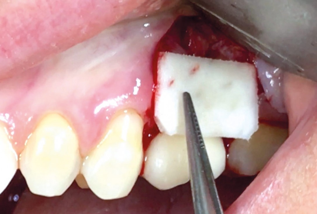 5/9 Soft tissue thickening with mucoderm® - Dr. G. de Deus