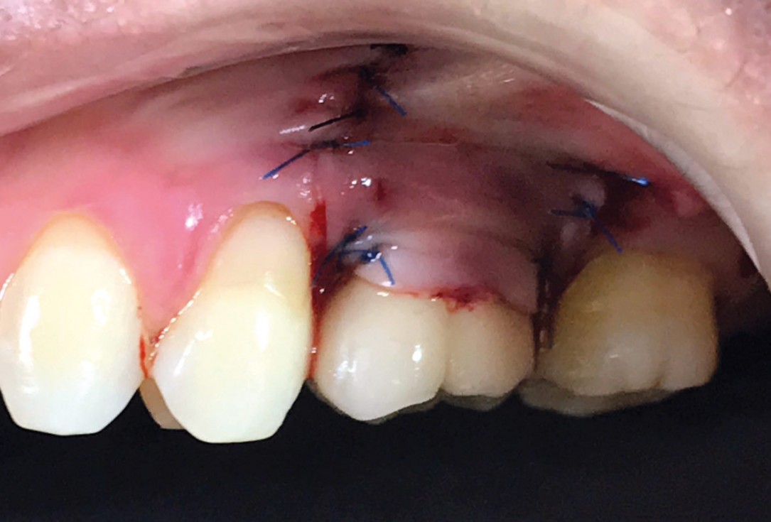 6/9 Soft tissue thickening with mucoderm® - Dr. G. de Deus