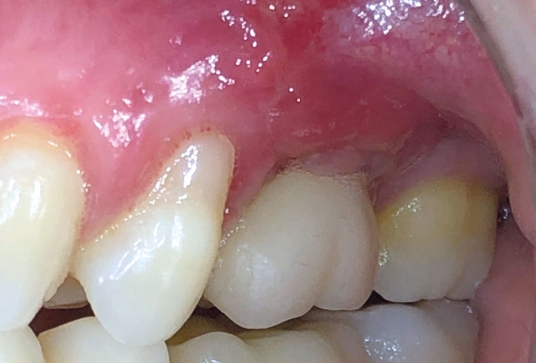 7/9 Soft tissue thickening with mucoderm® - Dr. G. de Deus