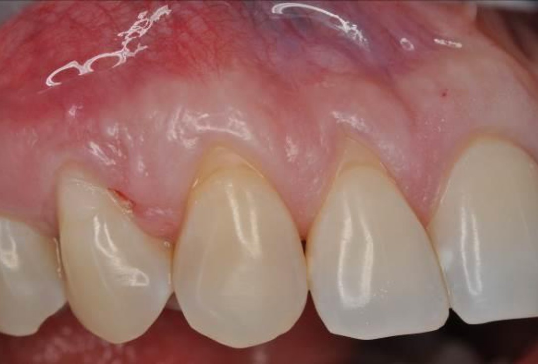 01/06 Multiple gingival recessions treated by MCAF in conjunction with mucoderm® and Straumann® Emdogain® - Hangyási
