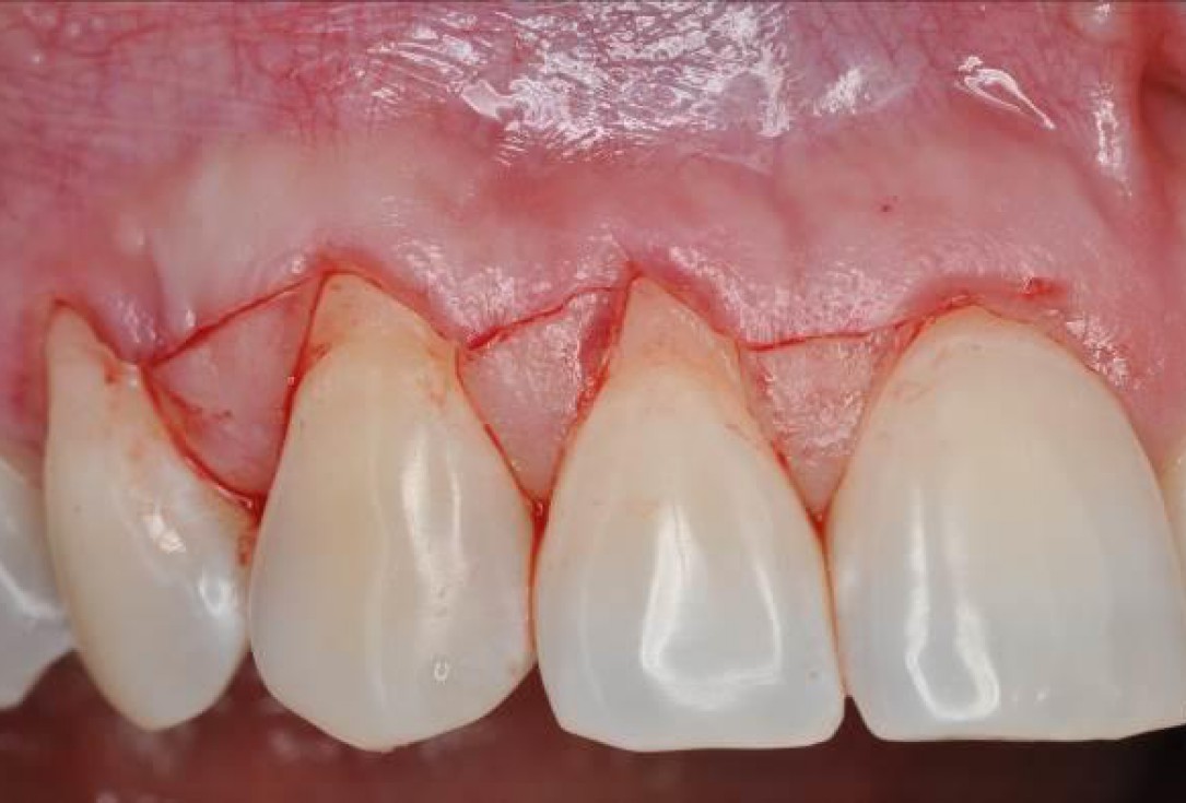 02/06 Multiple gingival recessions treated by MCAF in conjunction with mucoderm® and Straumann® Emdogain® - Hangyási