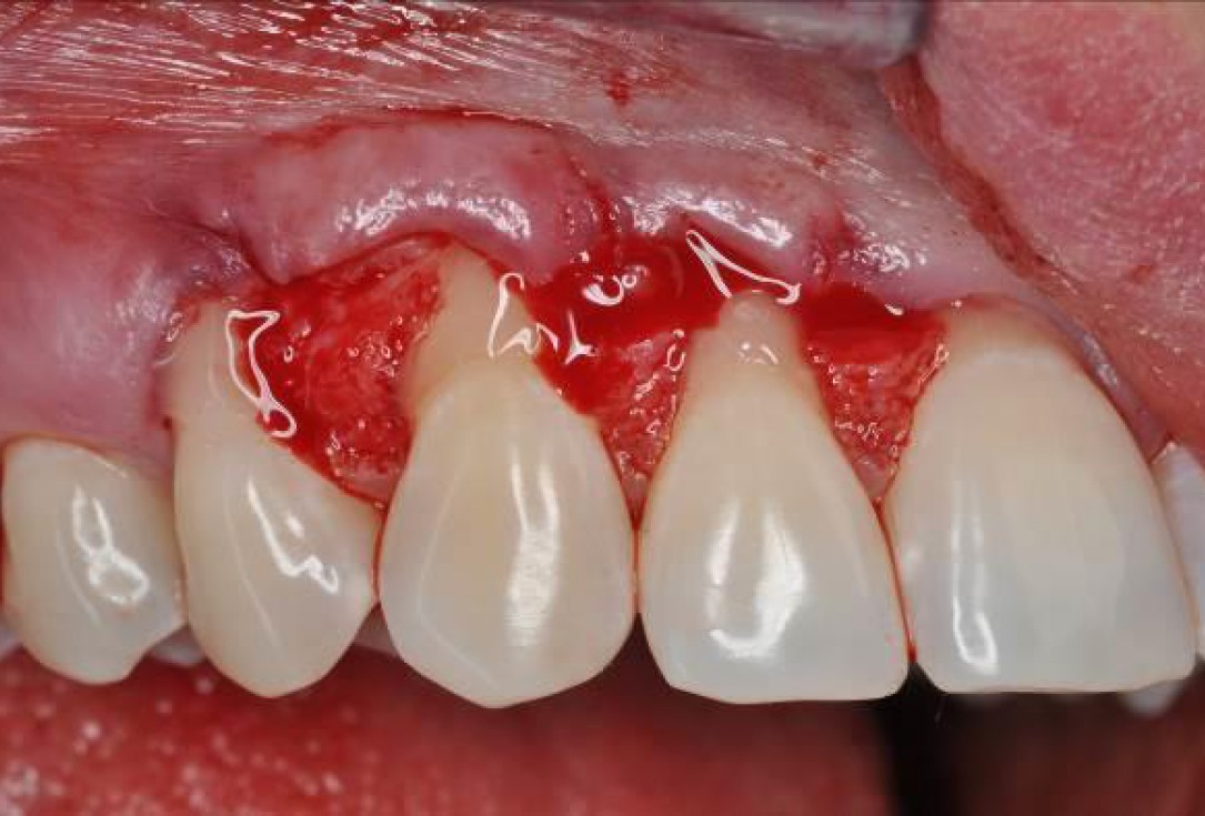 03/06 Multiple gingival recessions treated by MCAF in conjunction with mucoderm® and Straumann® Emdogain® - Hangyási
