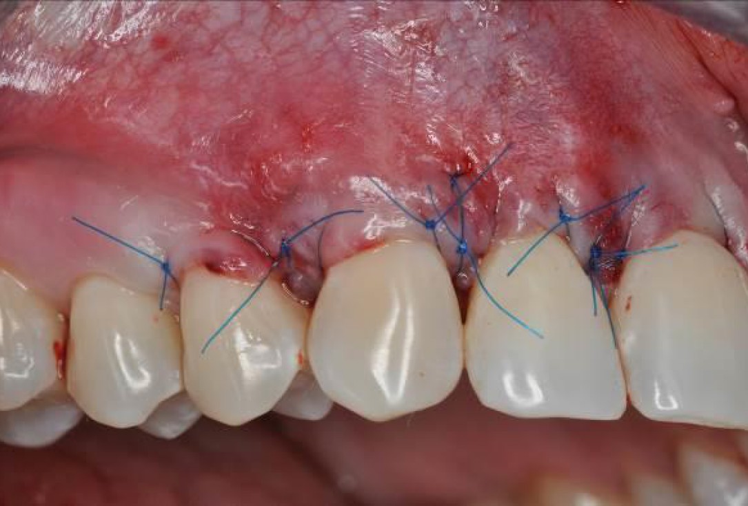 05/06 Multiple gingival recessions treated by MCAF in conjunction with mucoderm® and Straumann® Emdogain® - Hangyási