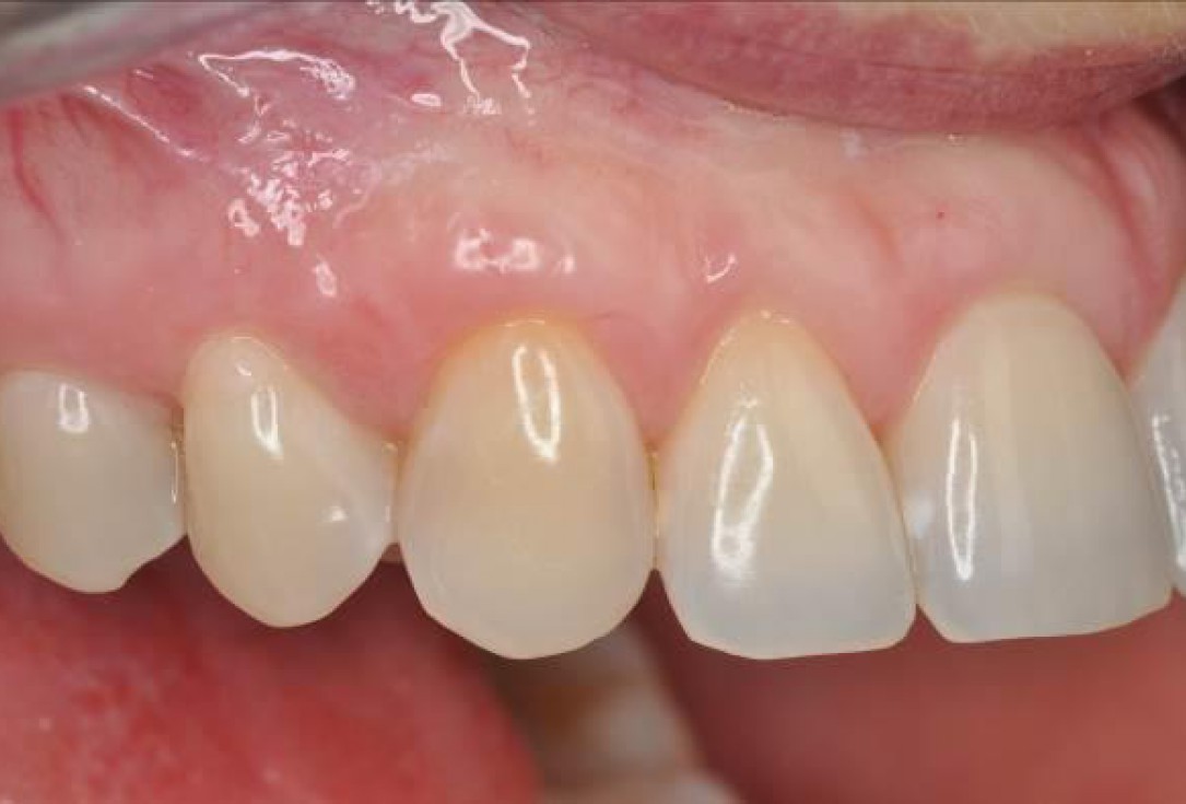 06/06 Multiple gingival recessions treated by MCAF in conjunction with mucoderm® and Straumann® Emdogain® - Hangyási