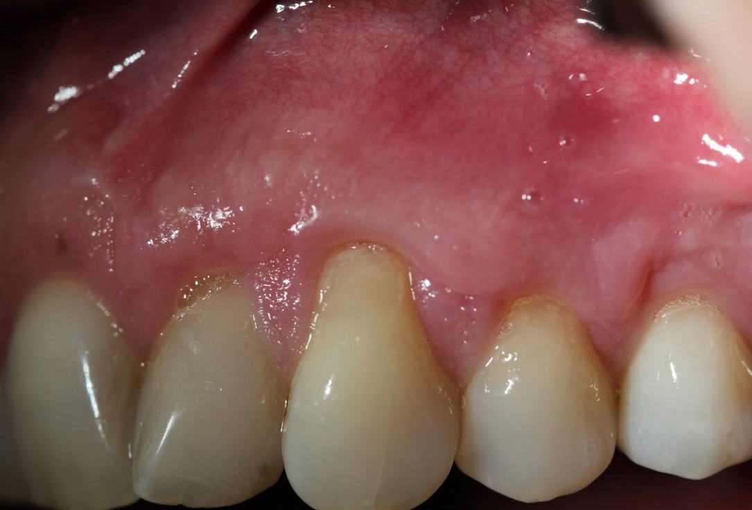 Multiple gingival recessions treated by MCAF in conjunction with mucoderm® - Hägewald