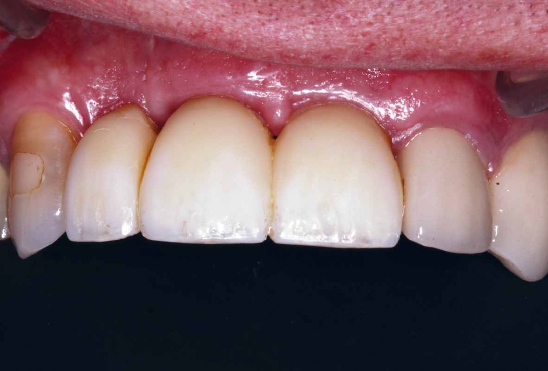 GBR and soft tissue augmentation with cerabone® and mucoderm® - H. Maghaireh & V. Ivancheva