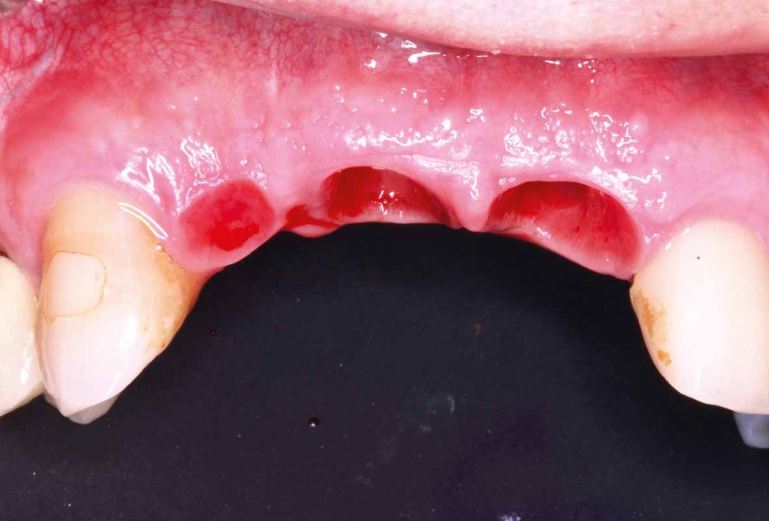 GBR and soft tissue augmentation with cerabone® and mucoderm® - H. Maghaireh & V. Ivancheva