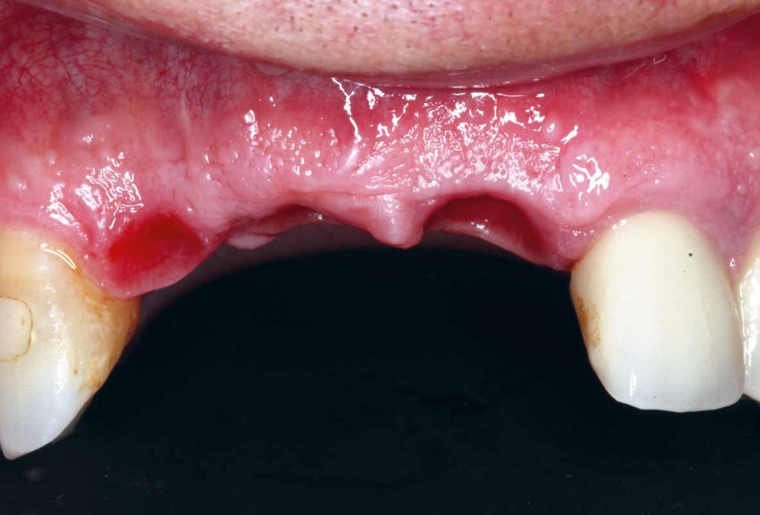 GBR and soft tissue augmentation with cerabone® and mucoderm® - H. Maghaireh & V. Ivancheva