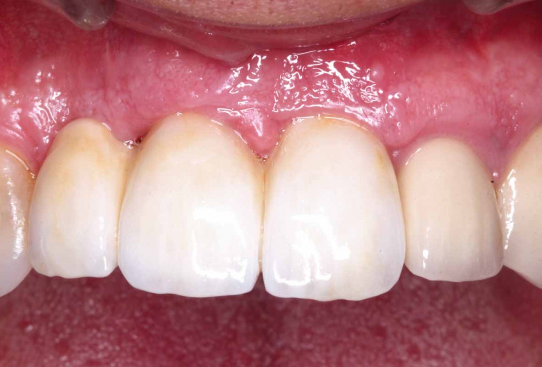 GBR and soft tissue augmentation with cerabone® and mucoderm® - H. Maghaireh & V. Ivancheva