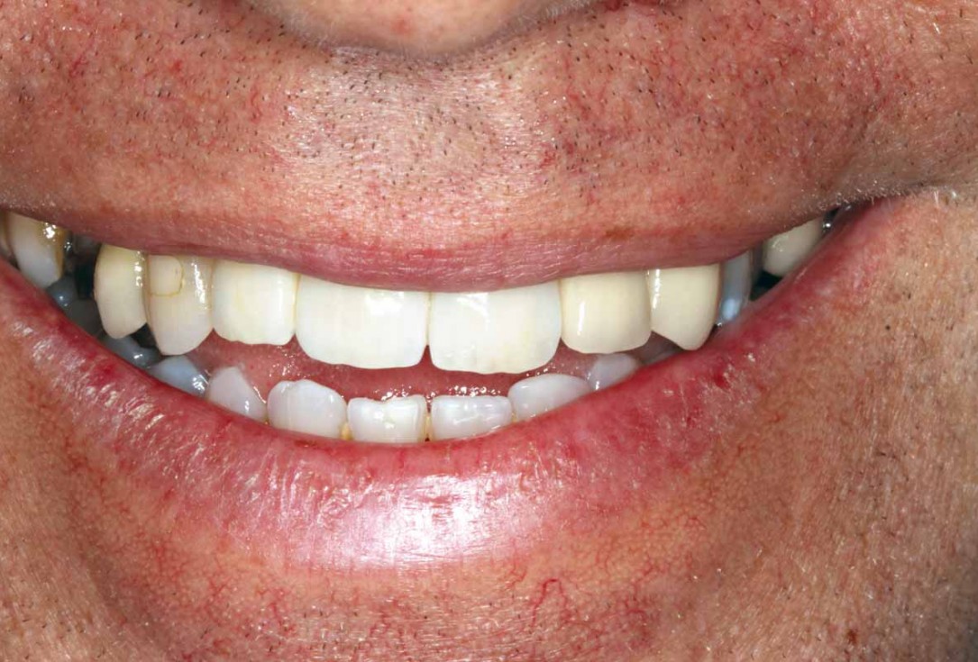 GBR and soft tissue augmentation with cerabone® and mucoderm® - H. Maghaireh & V. Ivancheva