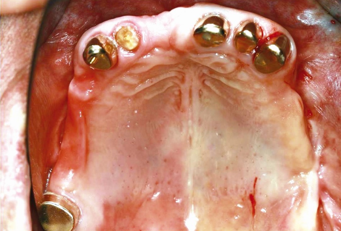 Three-dimensional augmentation in the mandible with maxgraft® cortico –  J. Kielhorn and Dr. S. Hölzer