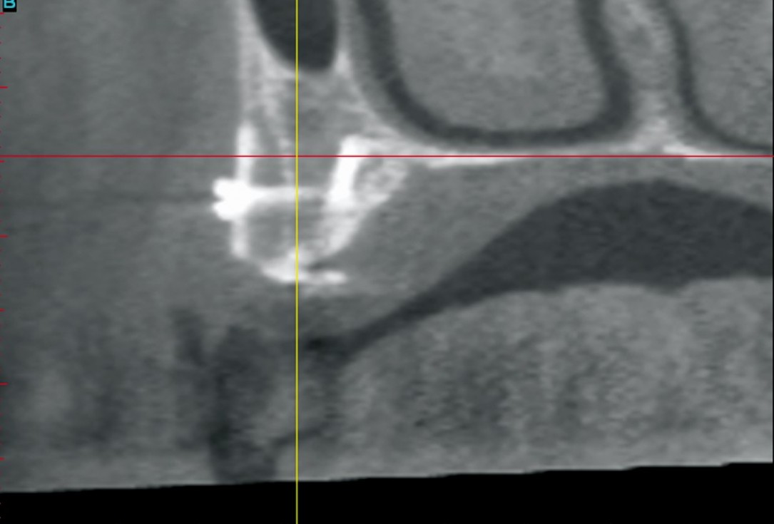 Three-dimensional augmentation in the mandible with maxgraft® cortico –  J. Kielhorn and Dr. S. Hölzer