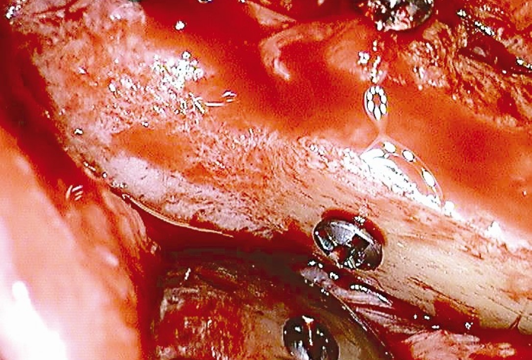 Three-dimensional augmentation in the mandible with maxgraft® cortico –  J. Kielhorn and Dr. S. Hölzer