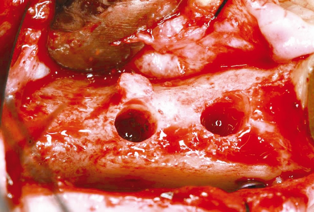 Three-dimensional augmentation in the mandible with maxgraft® cortico –  J. Kielhorn and Dr. S. Hölzer