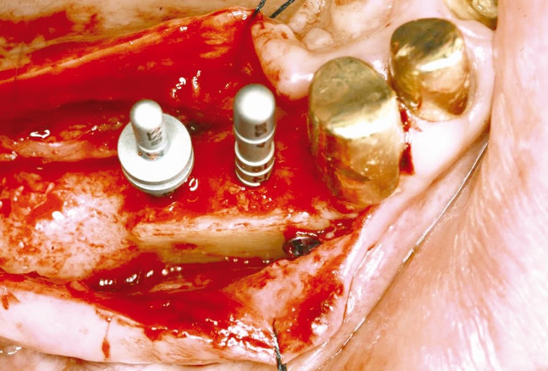 Three-dimensional augmentation in the mandible with maxgraft® cortico –  J. Kielhorn and Dr. S. Hölzer