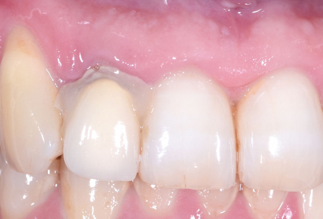Immediate implant placement in the maxilla with contour GBR - Dr. K. Loukas