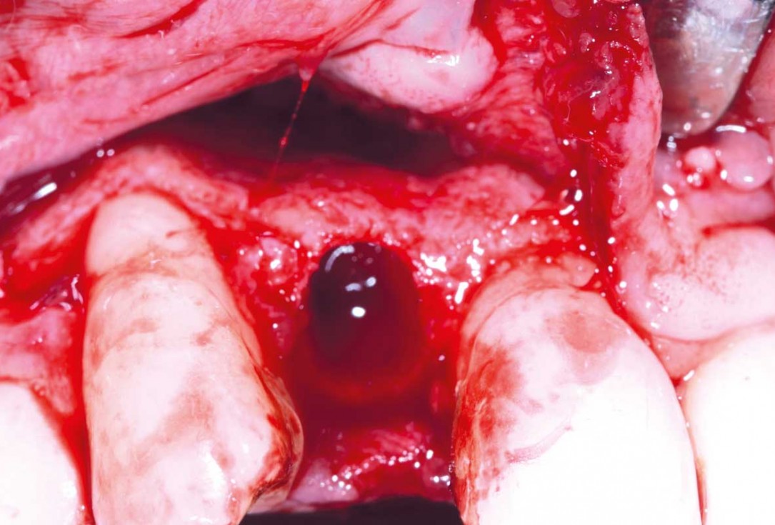 Immediate implant placement in the maxilla with contour GBR - Dr. K. Loukas