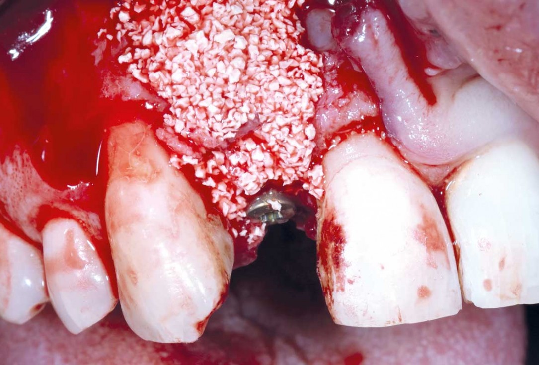 Immediate implant placement in the maxilla with contour GBR - Dr. K. Loukas