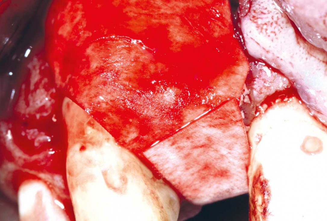 Immediate implant placement in the maxilla with contour GBR - Dr. K. Loukas