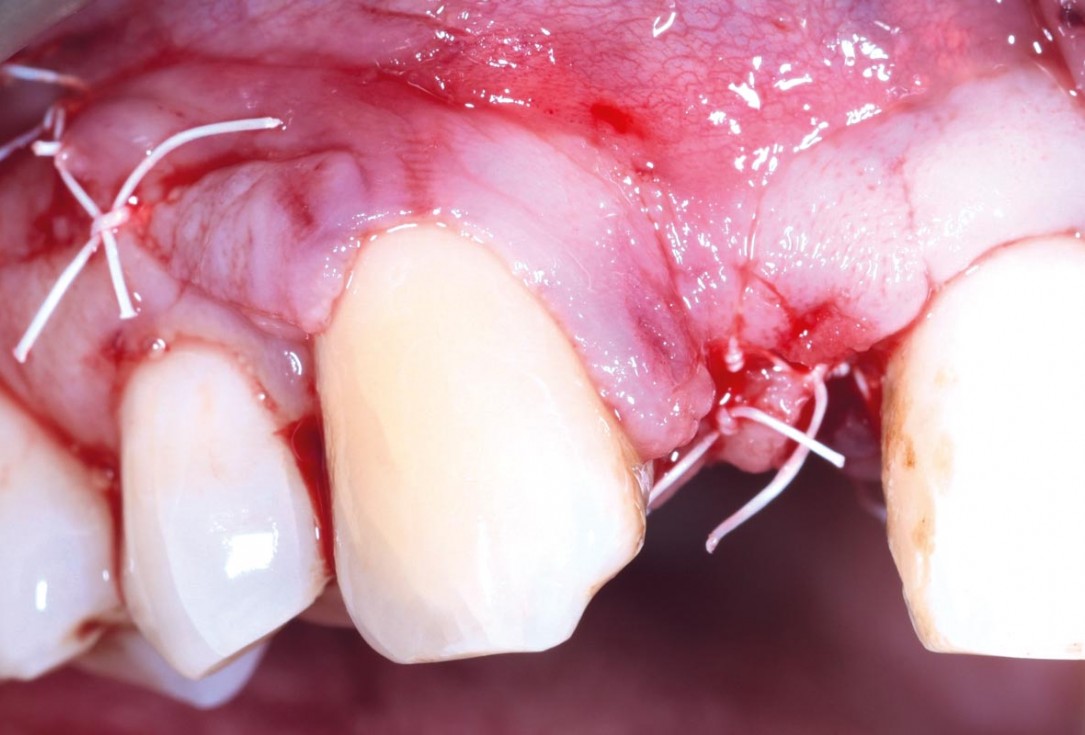 Immediate implant placement in the maxilla with contour GBR - Dr. K. Loukas