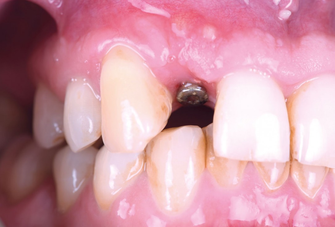 Immediate implant placement in the maxilla with contour GBR - Dr. K. Loukas