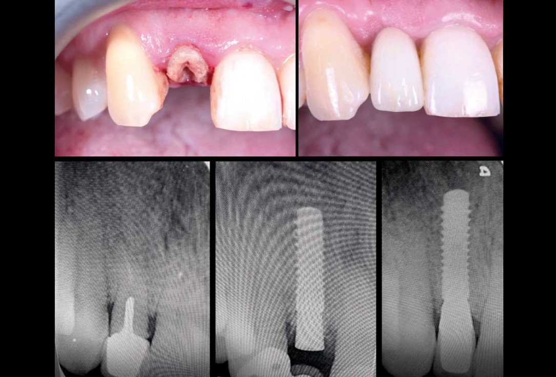 Immediate implant placement in the maxilla with contour GBR - Dr. K. Loukas