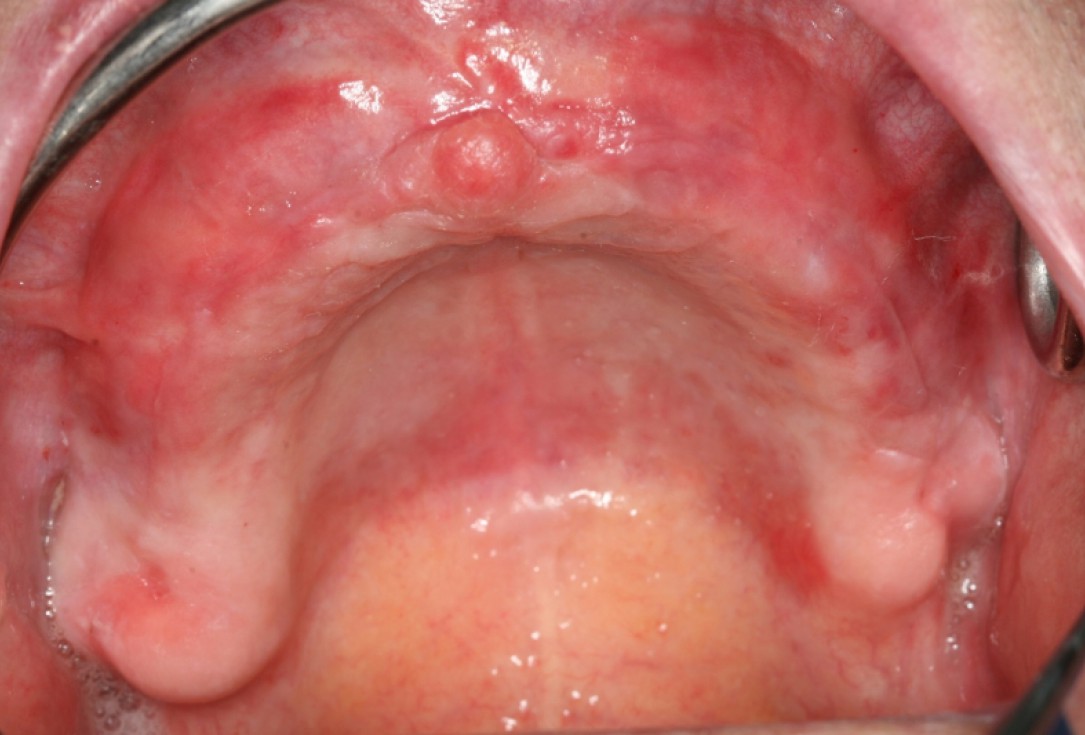 07/10 botiss maxresorb® and collprotect® membrane for bone splitting - case by Dr J Neugebauer