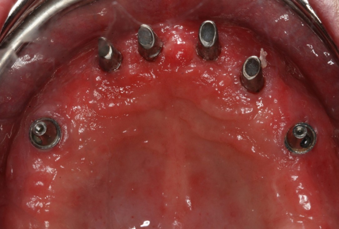 09/10 botiss maxresorb® and collprotect® membrane for bone splitting - case by Dr J Neugebauer