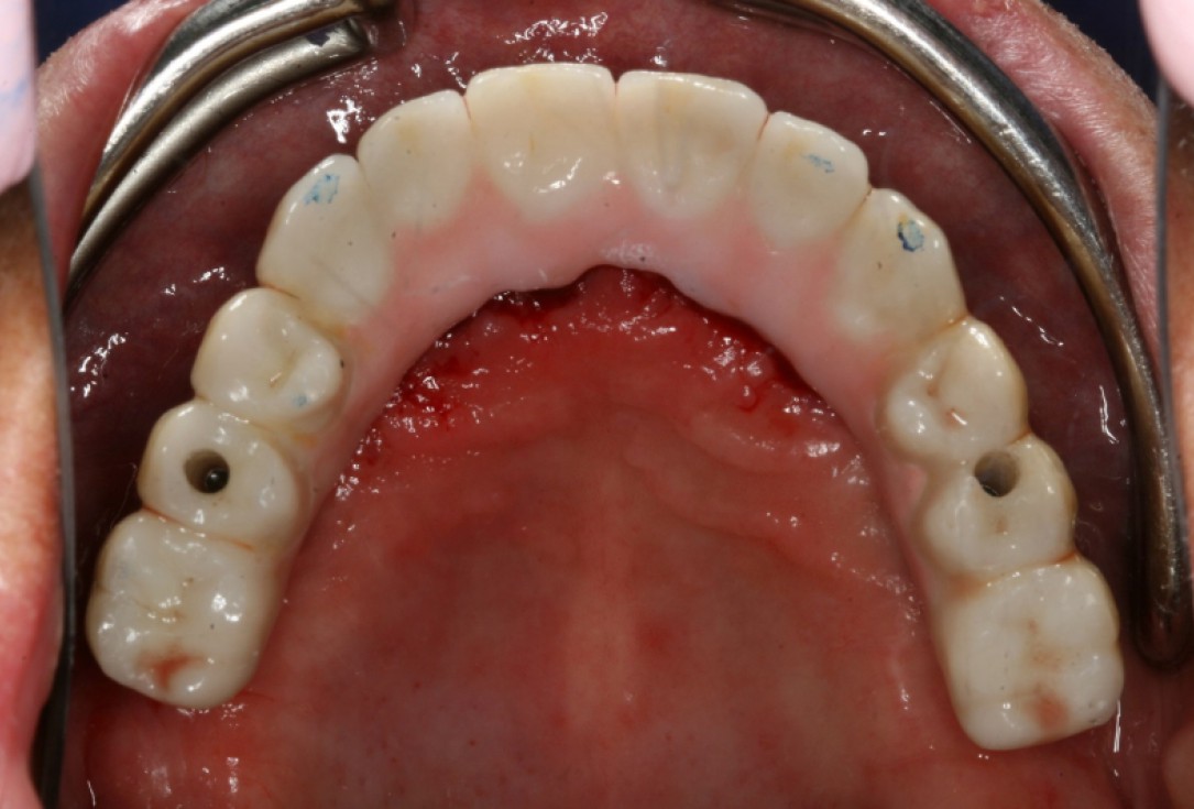 10/10 botiss maxresorb® and collprotect® membrane for bone splitting - case by Dr J Neugebauer