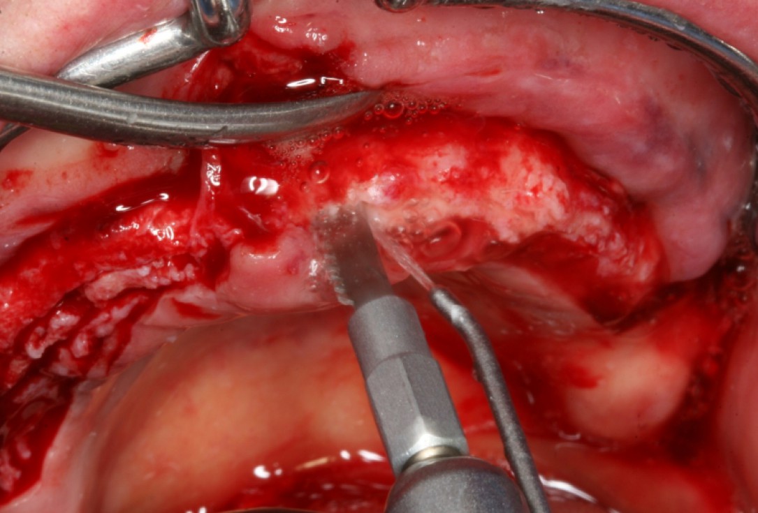 02/10 botiss maxresorb® and collprotect® membrane for bone splitting - case by Dr J Neugebauer