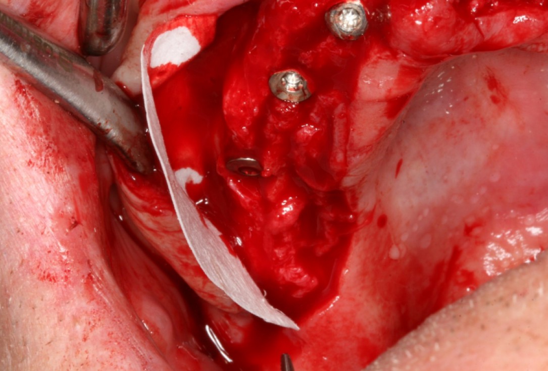 03/10 botiss maxresorb® and collprotect® membrane for bone splitting - case by Dr J Neugebauer