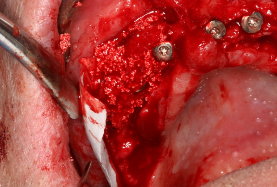 04/10 botiss maxresorb® and collprotect® membrane for bone splitting - case by Dr J Neugebauer